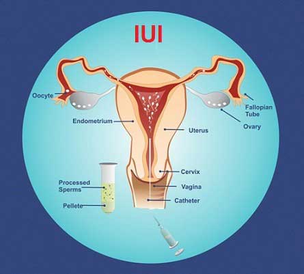 Intrauterine Insemination Services